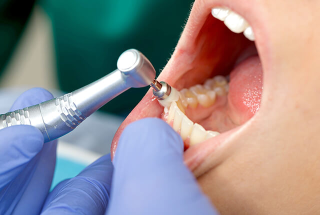 PMTC（Professional Mechanical Tooth Cleaning）
