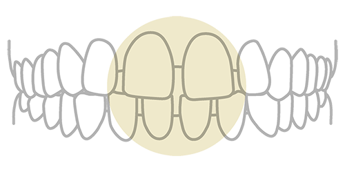 空隙歯列（すきっ歯）