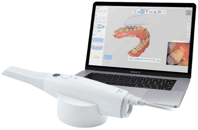 口腔内スキャナーによる型取り