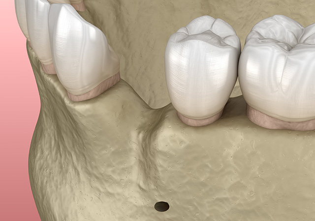 骨移植が必要になる場合は？