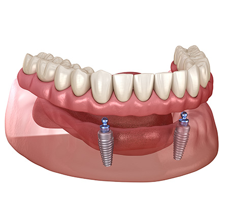 インプラント義歯