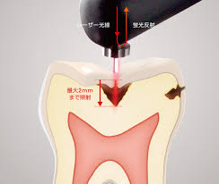 レーザー光で虫歯を検知