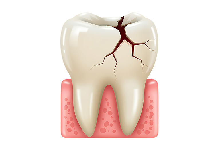 折れた歯のイメージ