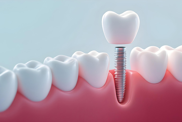 欠損部へのリカバリー
