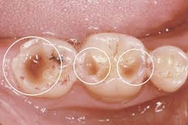 臼歯部のファセット