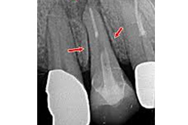 レントゲン写真内の歯根膜腔の拡大
