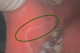 頬粘膜の咬合線（咬合縫線・頬粘膜圧痕）