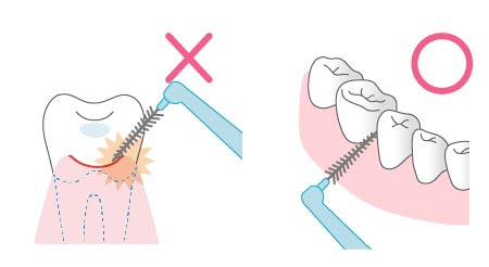 歯ぐきを傷付けないように気を付ける